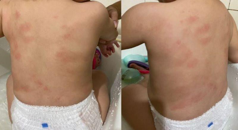 Mãe denuncia creche municipal após encontrar vários hematomas na filha de 1 ano em MT